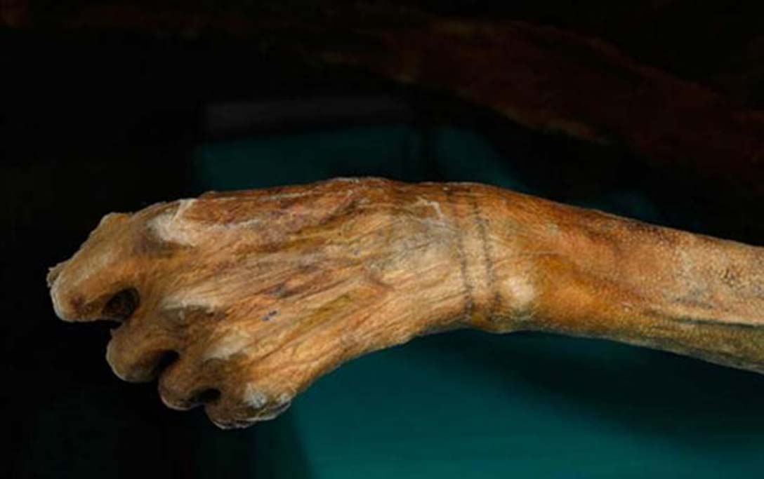 Se observan dos bandas tatuadas en torno a la muñeca de Ötzi. (radiolab.org)