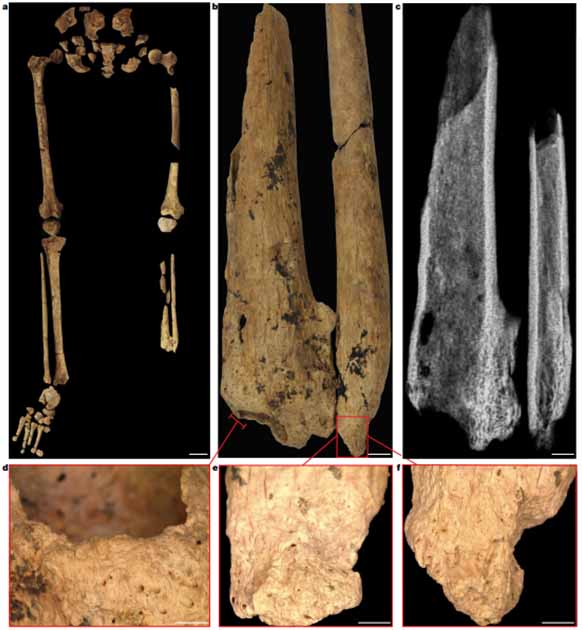 Sitio amputado quirúrgicamente de la tibia y el peroné izquierdos que muestran evidencia de amputación. (Maloney, et al. / Nature)