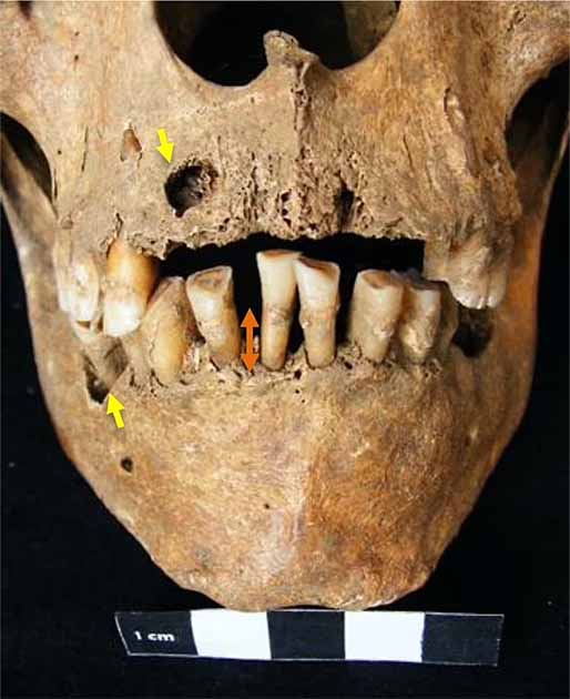 Los dientes del portugués del siglo XI d. C., que padecía el síndrome de Klinefelter, eran más largos que el promedio y sufría una enfermedad debilitante de las encías. (The Lancet)