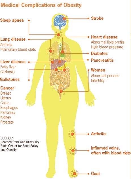 Las complicaciones médicas de la obesidad podrían empeorar el coronavirus en algunas personas. (Smallman12q / Dominio público)