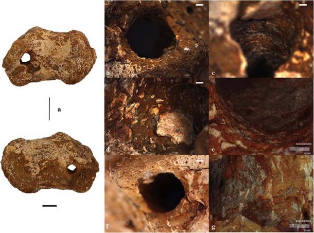 Calcáneo derecho del siglo I d. C. Gavello, Italia, que muestra una posible evidencia de crucifixión. Esta evidencia arqueológica ha proporcionado nuevas pistas sobre la muerte de Jesús. (Emanuela Gualdi-Russo y Ursula Thun Hohenstein / Universidad de Ferrara)