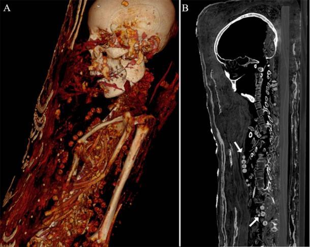 Ambas hembras fueron enterradas con hermosos collares. La tomografía computarizada mostró las cuentas del collar de la mujer alrededor del cuello y el cuerpo. (Zesch S, et al. PLOS One / CC BY 4.0)