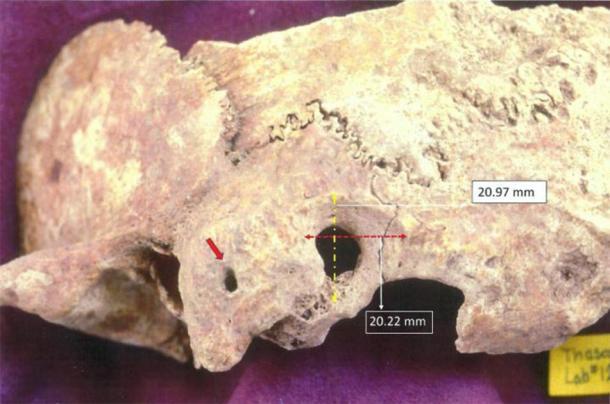 Vista ectocraneal de la cirugía cerebral de muestra paleopatológica: a) la flecha roja apunta al orificio en el proceso mastoideo, yb) las dimensiones de la preparación quirúrgica periféricas a la trepanación. (Anagnostis P. Agelarakis / Universidad de Adelphi)