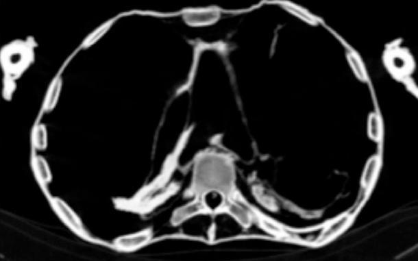 Las tomografías computarizadas revelan que la princesa egipcia murió de un ataque cardíaco masivo. Los resultados muestran que sufrió un caso severo de aterosclerosis que afectó varias arterias. (Cairo University)