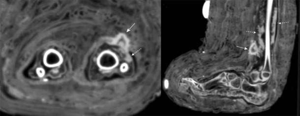 Tomografías computarizadas de infección de tejidos blandos en la parte inferior de la pierna de la momia infantil. La exploración revela una masa consistente con absceso seco (indicado con flechas punteadas) debajo del vendaje. (Panzer et. al / Revista Internacional de Paleopatología)