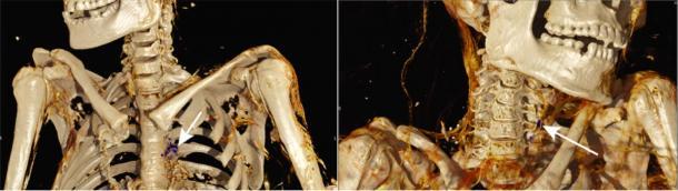 Imágenes de tomografía computarizada que muestran placas ateroscleróticas calcificadas. Las flechas indican placas ateroscleróticas calcificadas. (Imagen: © 2019 Wann LS et al. JAMA Network Open)