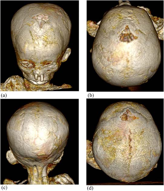 Representación de volumen 3D Reconstrucción por tomografía computarizada del cráneo de un niño del antiguo Egipto, que fue parte del estudio que reveló que la anemia era frecuente en los niños del antiguo Egipto. (Panzer et al. / CC BY-NC-ND 4.0)